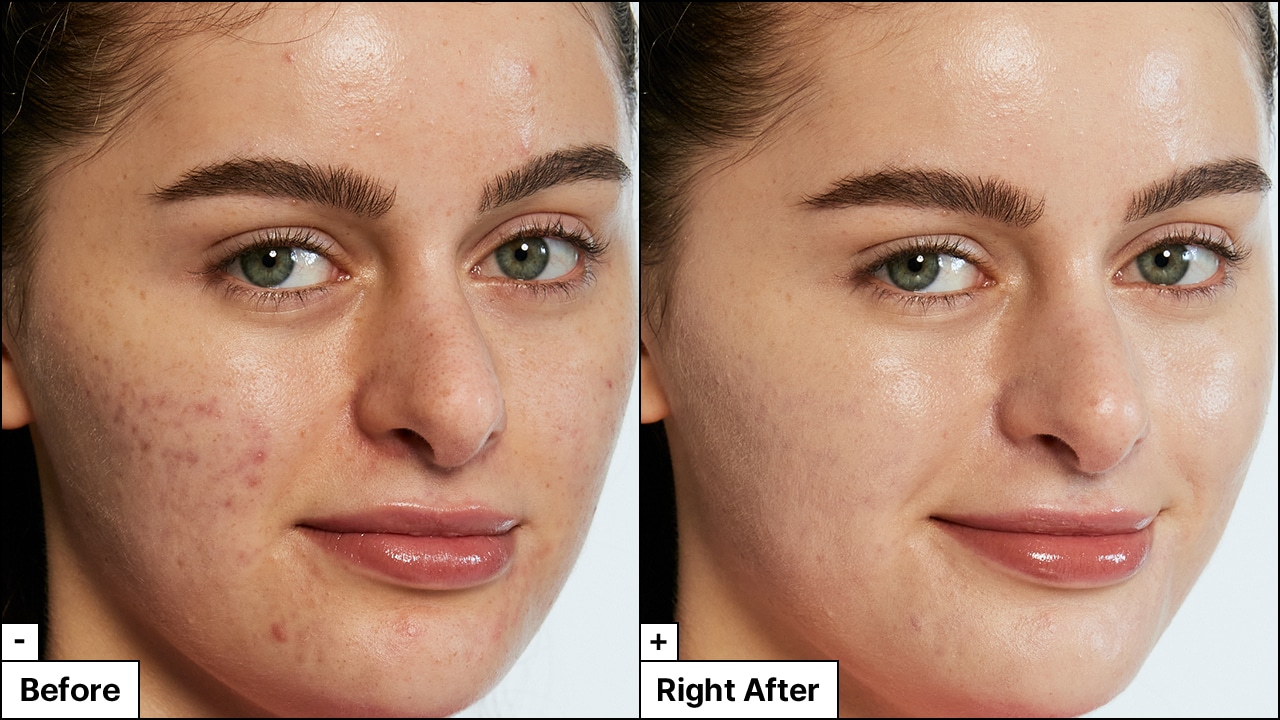 Close up image of woman's skin before and after applying So Soothing treatment. The After image reveals reduced redness and calm