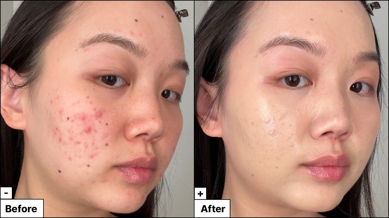 Model with acne reveals a refreshed face with reduced redness and coverage from her blemish marks.
