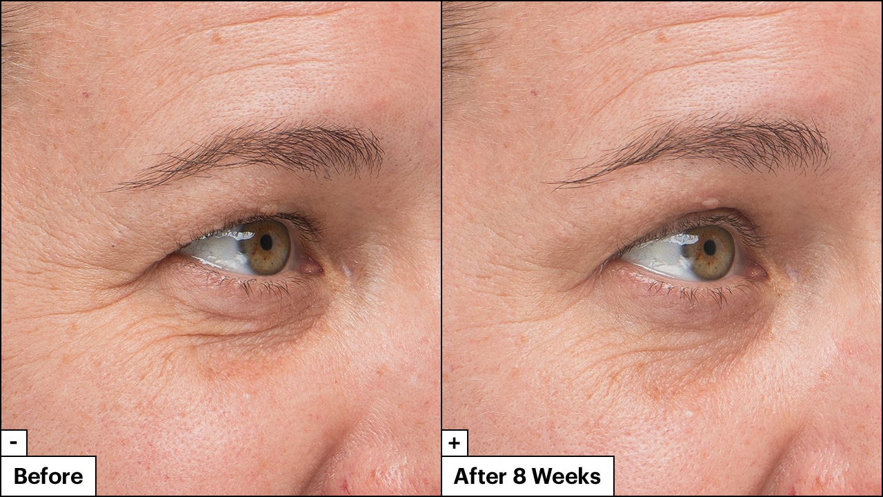 Close up of woman's face shows significant reduction in fine lines & wrinkles in her skin before & after 8 weeks. 