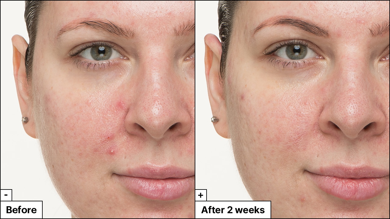 Close up image of woman's skin before and after applying So Soothing treatment. The After image reveals reduced redness and calm